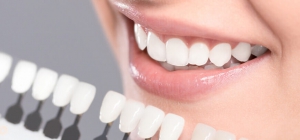 Cost of Dental Veneers