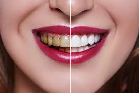 What are Dental Veneers?