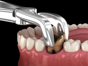 What is involved in a tooth extraction?