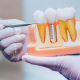 Dental Crowns: Types, Procedure Overview & Costs
