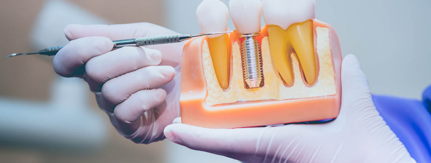 Dental Crowns: Types, Procedure Overview & Costs