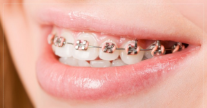 How Braces Straighten Teeth in Children and Adults