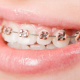 How Braces Straighten Teeth in Children and Adults