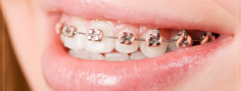 How Braces Straighten Teeth in Children and Adults