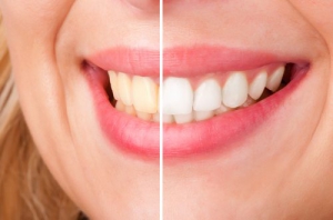 How Teeth Whitening Works