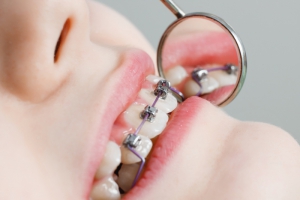 Close-up of teeth with kid braces at dentist reception in dental clinic.