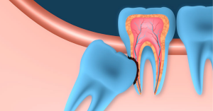 Tooth Extraction: What is Involved and What Does it Cost?