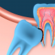 Tooth Extraction: What is Involved and What Does it Cost?