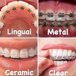 Types of braces