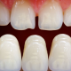 What are Dental Veneers & How Do They Work