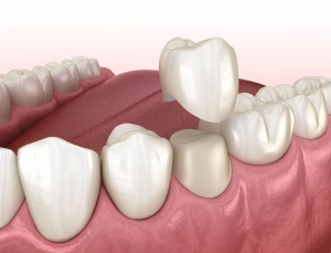 What is a Dental Crown