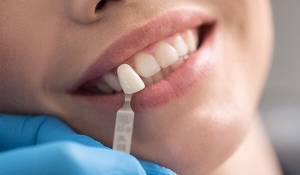 Why People Get Dental Veneers